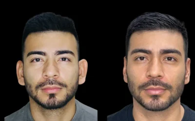 ¿La otoplastia deja cicatriz? Todo lo que debes saber sobre la cirugía de orejas