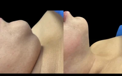 Lipopapada: cómo definir el rostro y mejorar el perfil facial