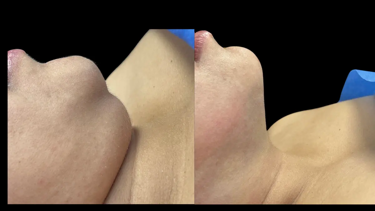 lipopapada Neiva