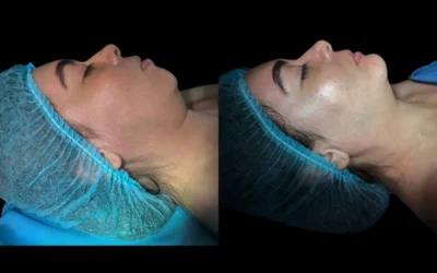 Mentoplastia: cómo mejorar el perfil facial de manera armónica